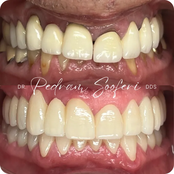 Dental implant before and after results at L.A. Smiles Dentistry, Los Angeles