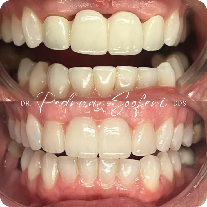 Dental implant before and after results at L.A. Smiles Dentistry, Los Angeles
