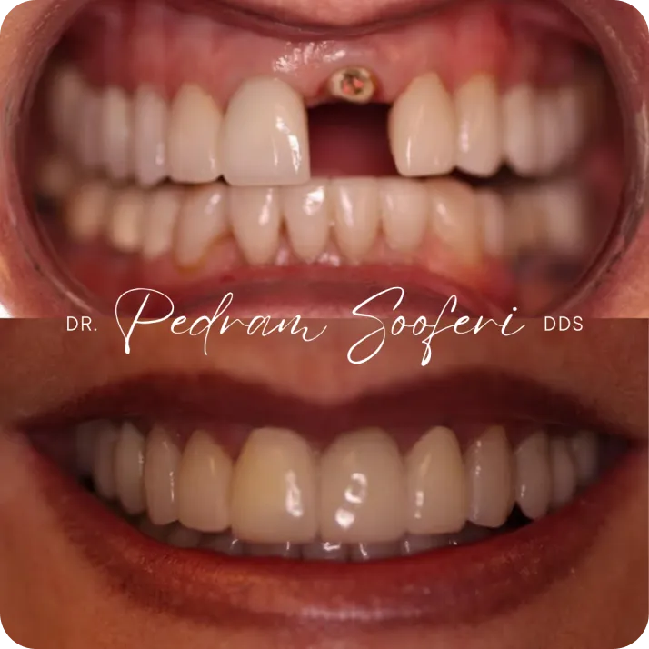 Dental implant before and after results at L.A. Smiles Dentistry, Los Angeles